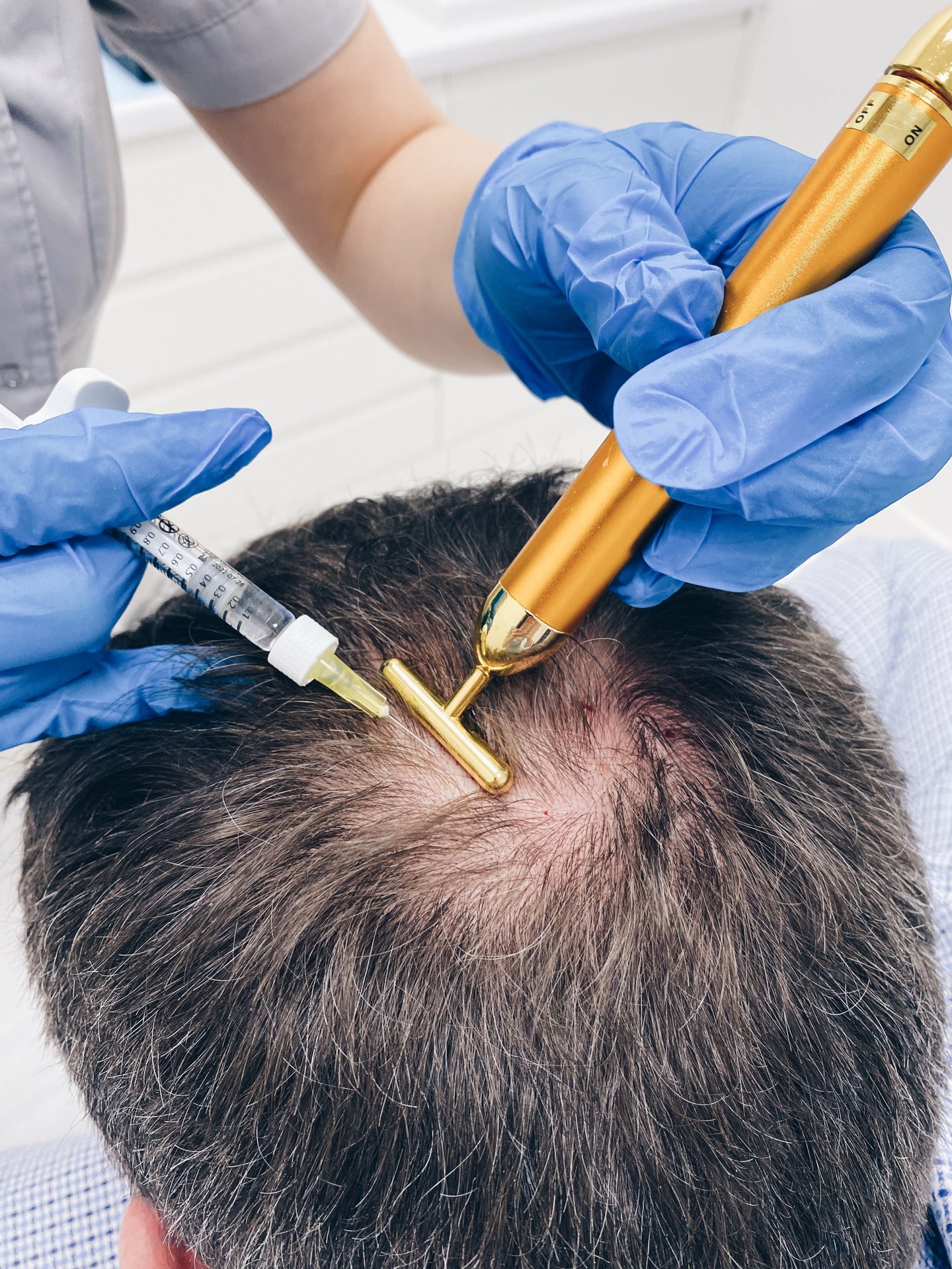dr cyj hair filler — skora glowy — szczyt glowy — Velvet Skin Clinic