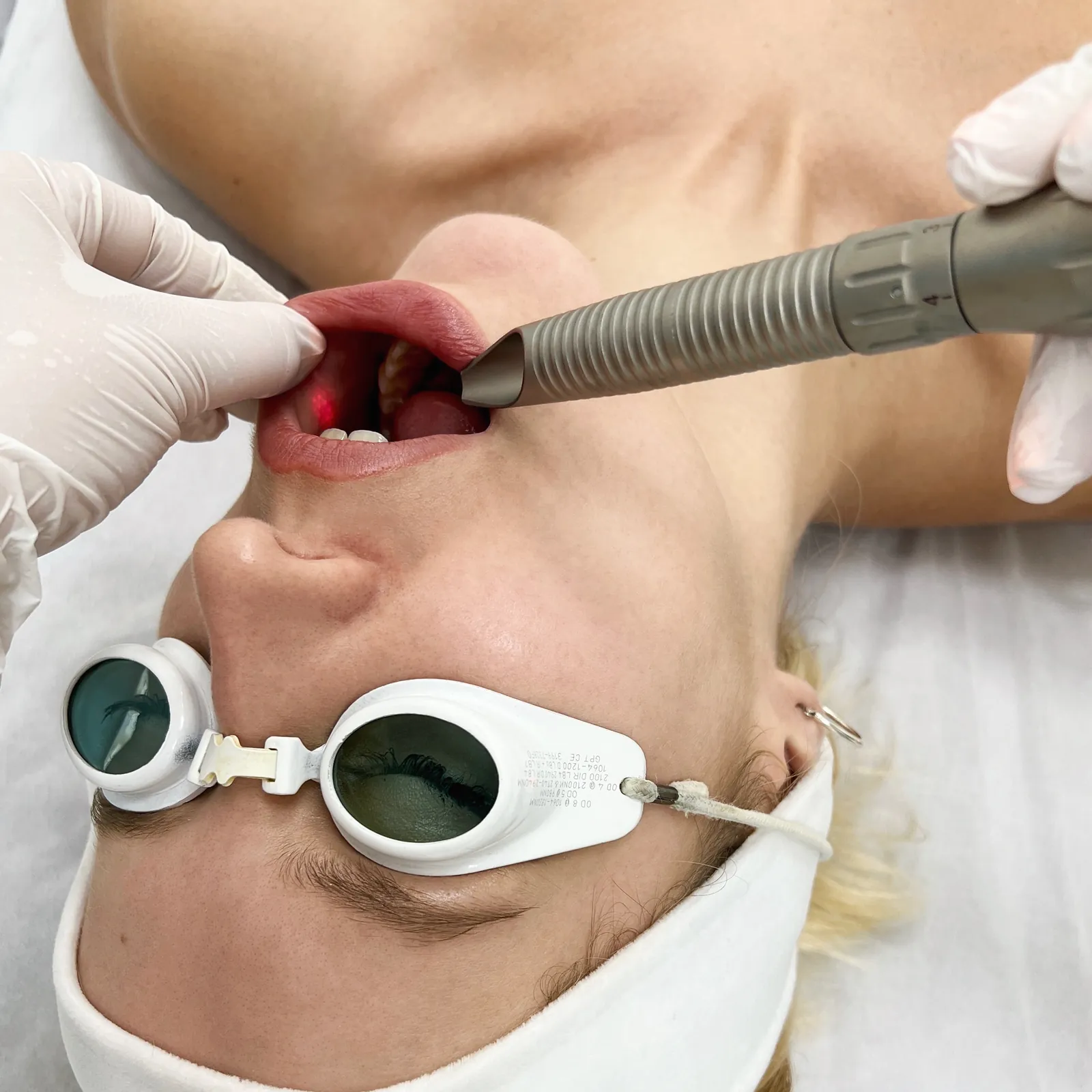 Endolifting Fotona™ — wewnątrzustny lifting bez wypełniaczy — Velvet Skin Clinic Warszawa