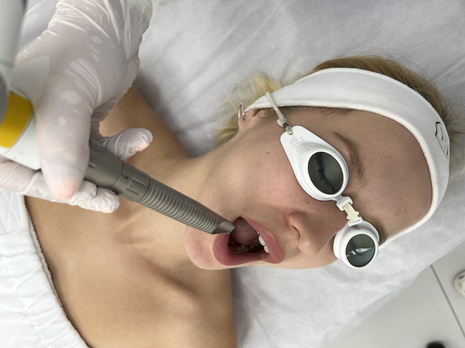 endolifting — twarz — wiotkosc skory — kat boczny — Velvet Skin Clinic