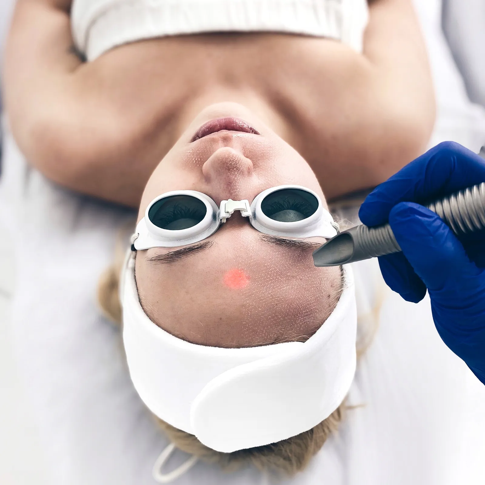 Fotoodmładzanie FRAC3™ — nieablacyjne frakcjonowanie 3D — Velvet Skin Clinic Warszawa