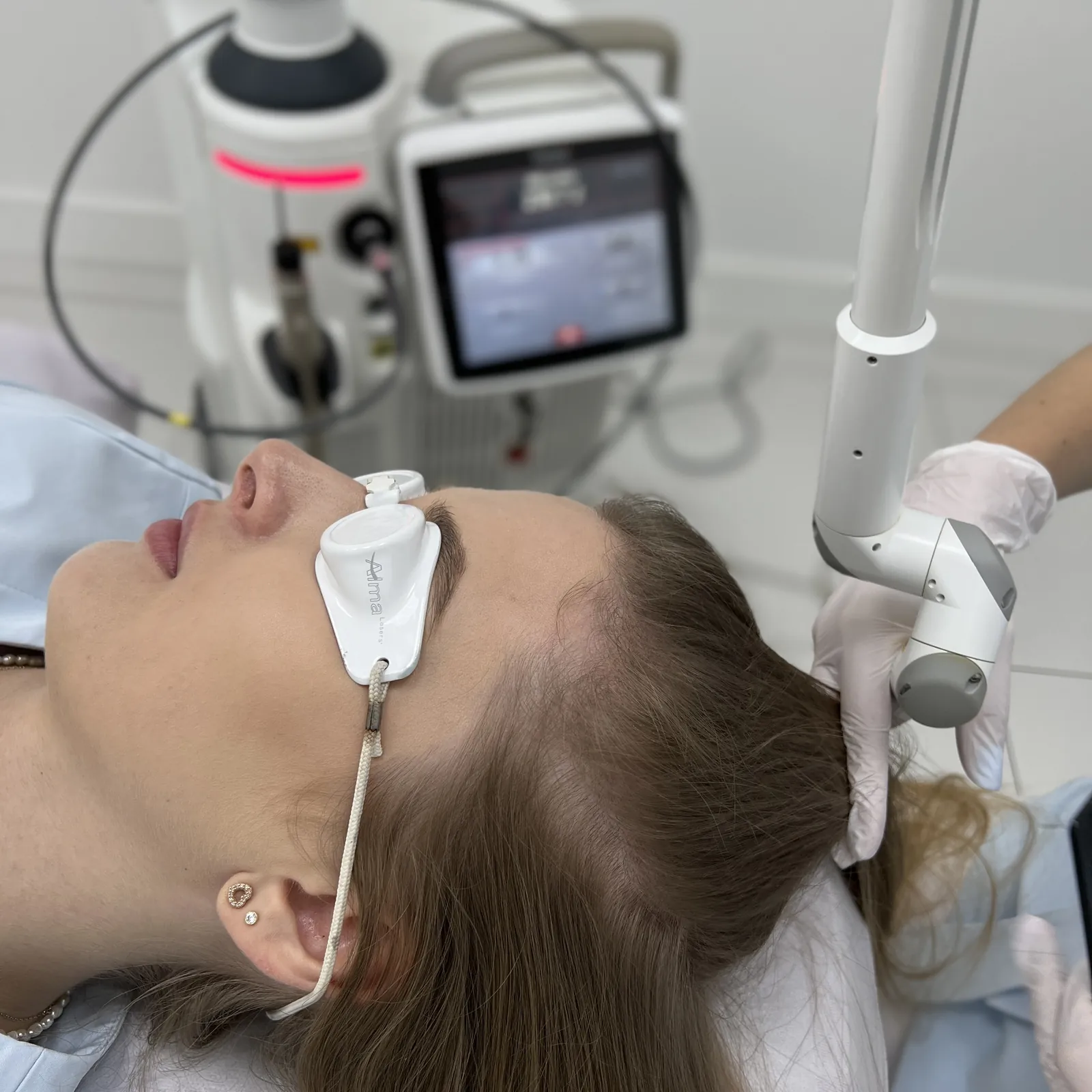 Hair Restoration Fotona™ — laserowa stymulacja wzrostu włosów — Velvet Skin Clinic Warszawa