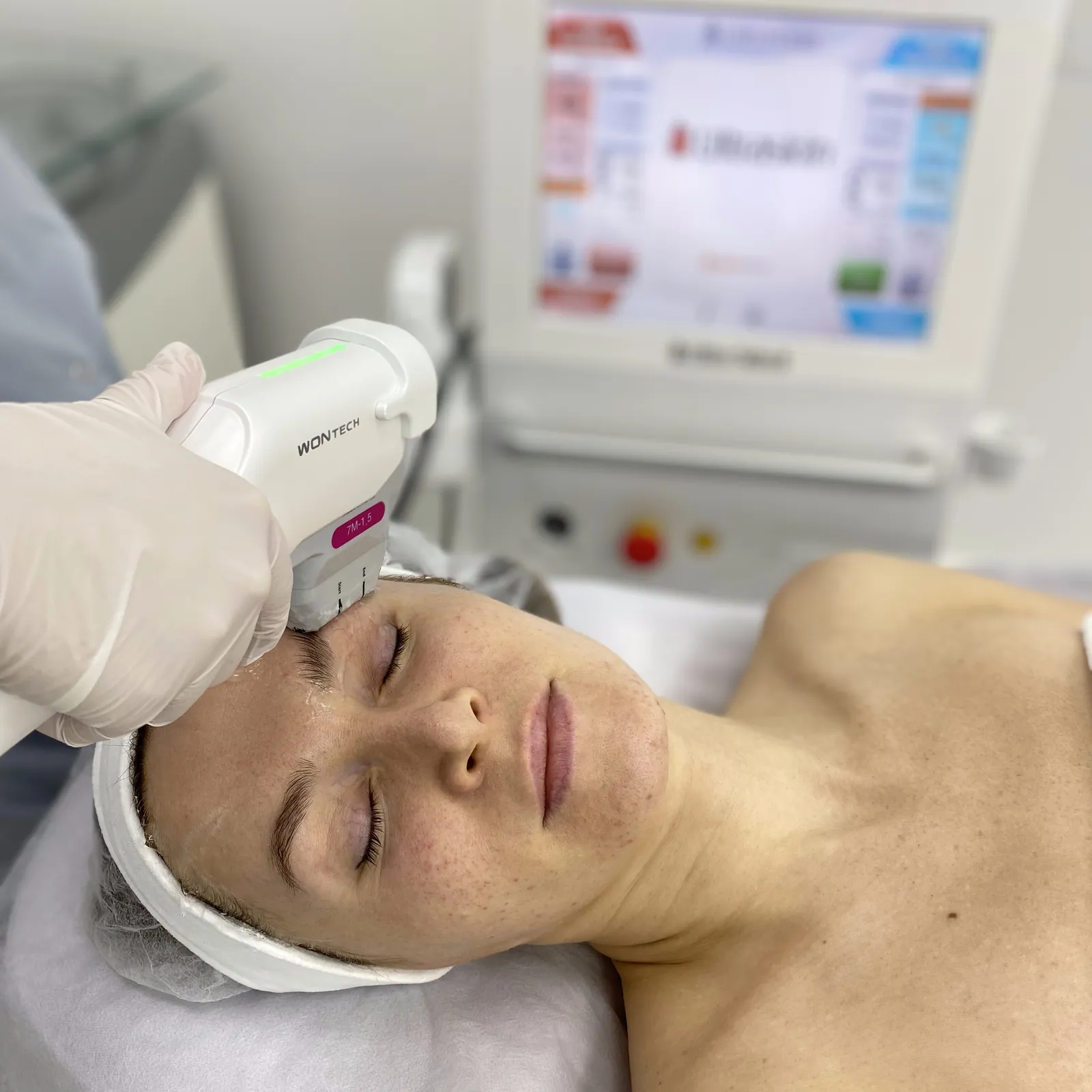 HIFU Ultraskin II Absolute - lifting SMAS — Velvet Skin Clinic Warszawa