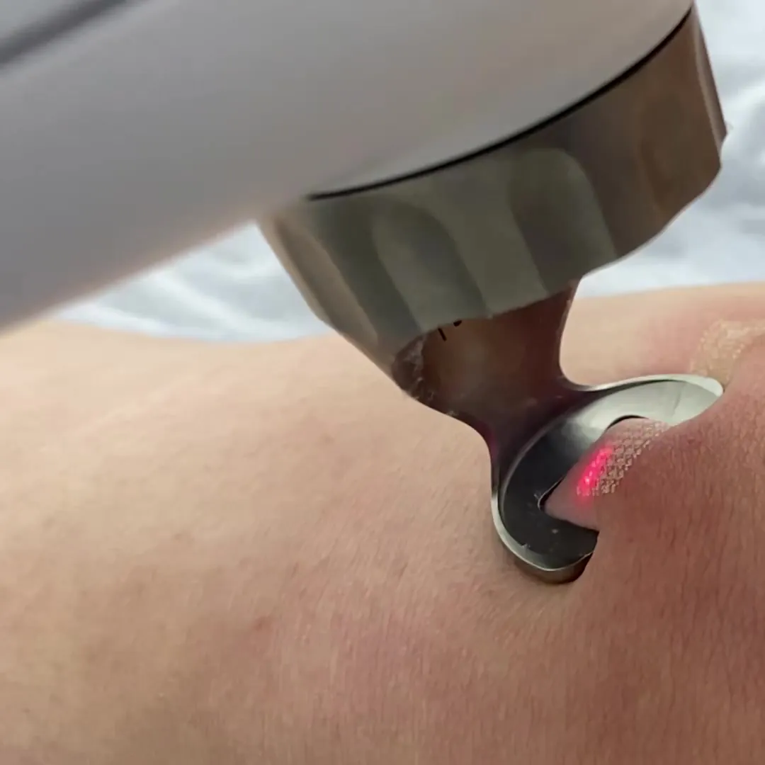 Laserowe usuwanie blizn Fotona™ — pourazowych, chirurgicznych i potrądzikowych — Velvet Skin Clinic Warszawa