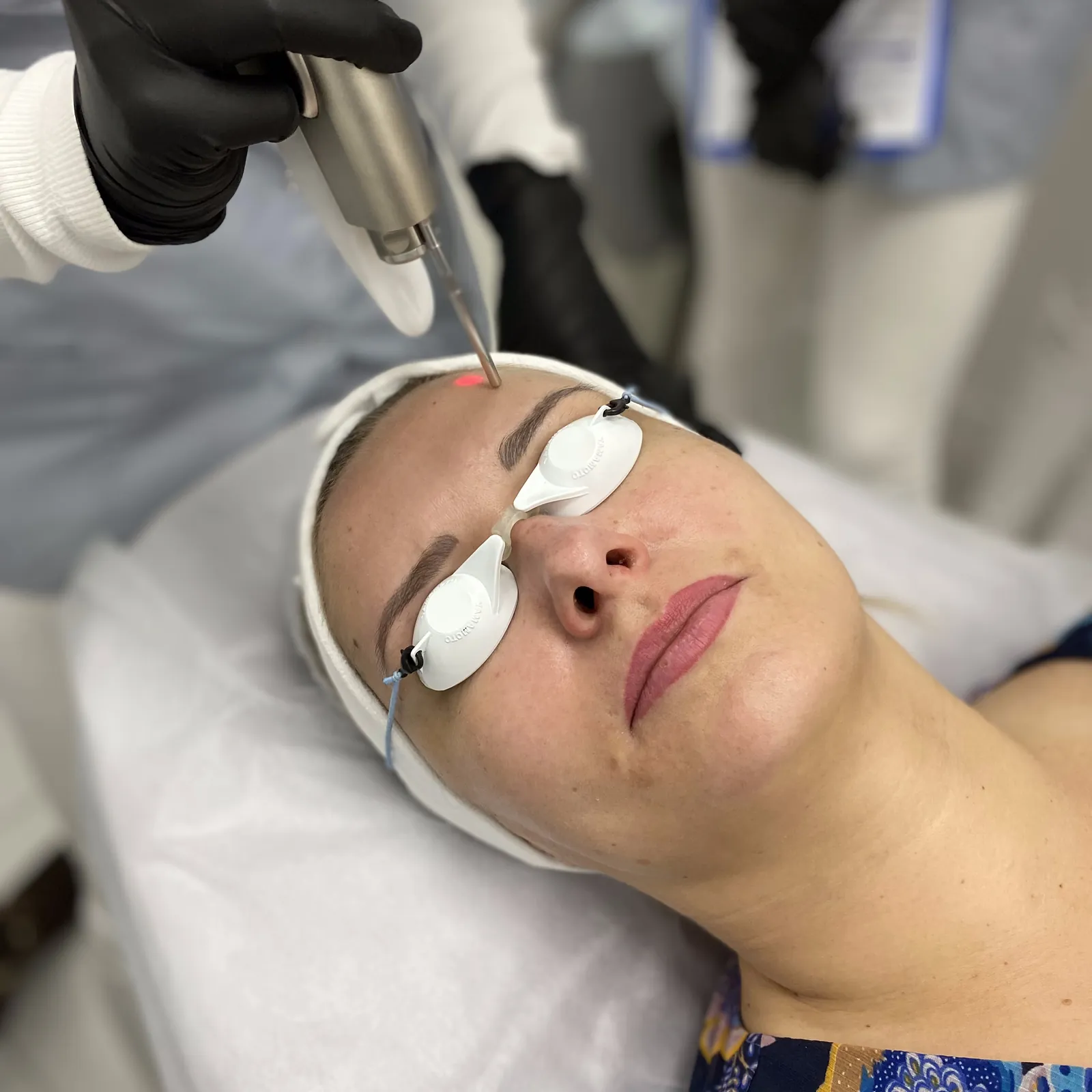 Laserowe usuwanie przebarwień — Velvet Skin Clinic Warszawa
