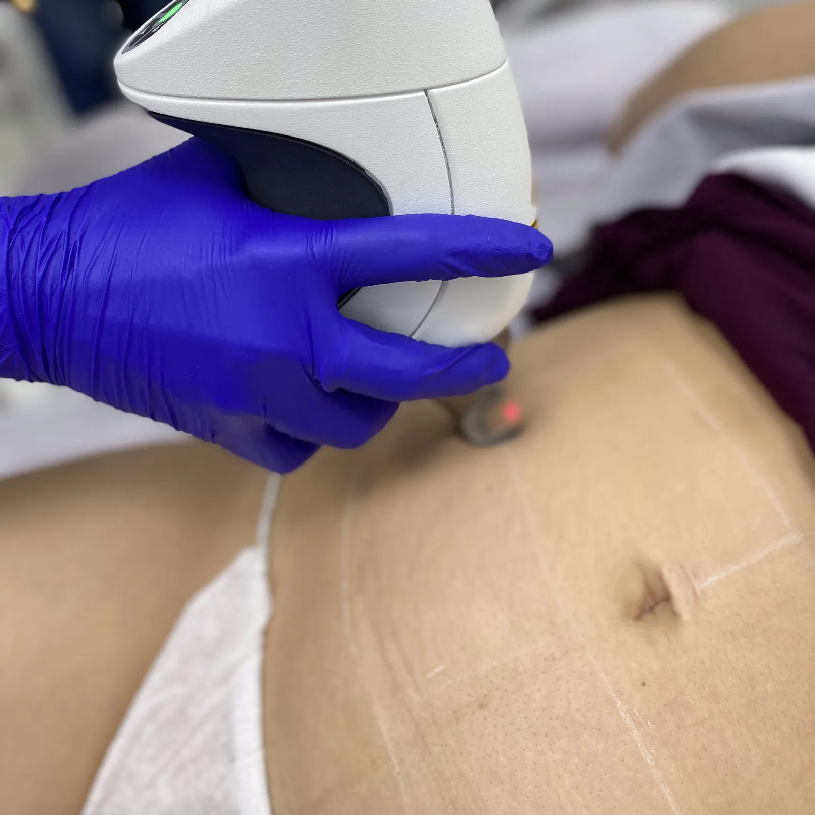 Laserowe usuwanie rozstępów Fotona™ — świeżych i wieloletnich — Velvet Skin Clinic Warszawa