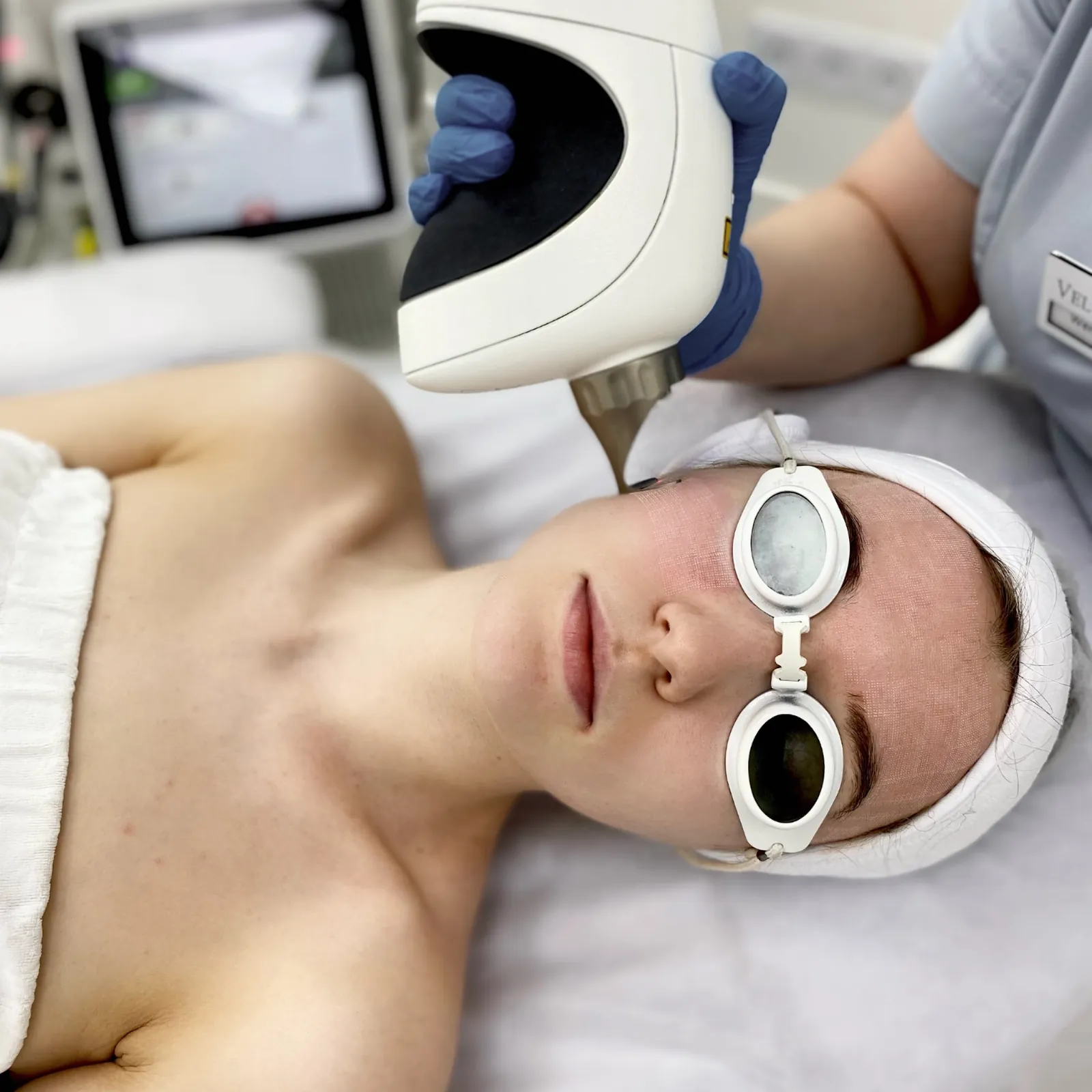 Peeling laserowy Fotona™ — kontrolowane złuszczenie i rewitalizacja skóry — Velvet Skin Clinic Warszawa