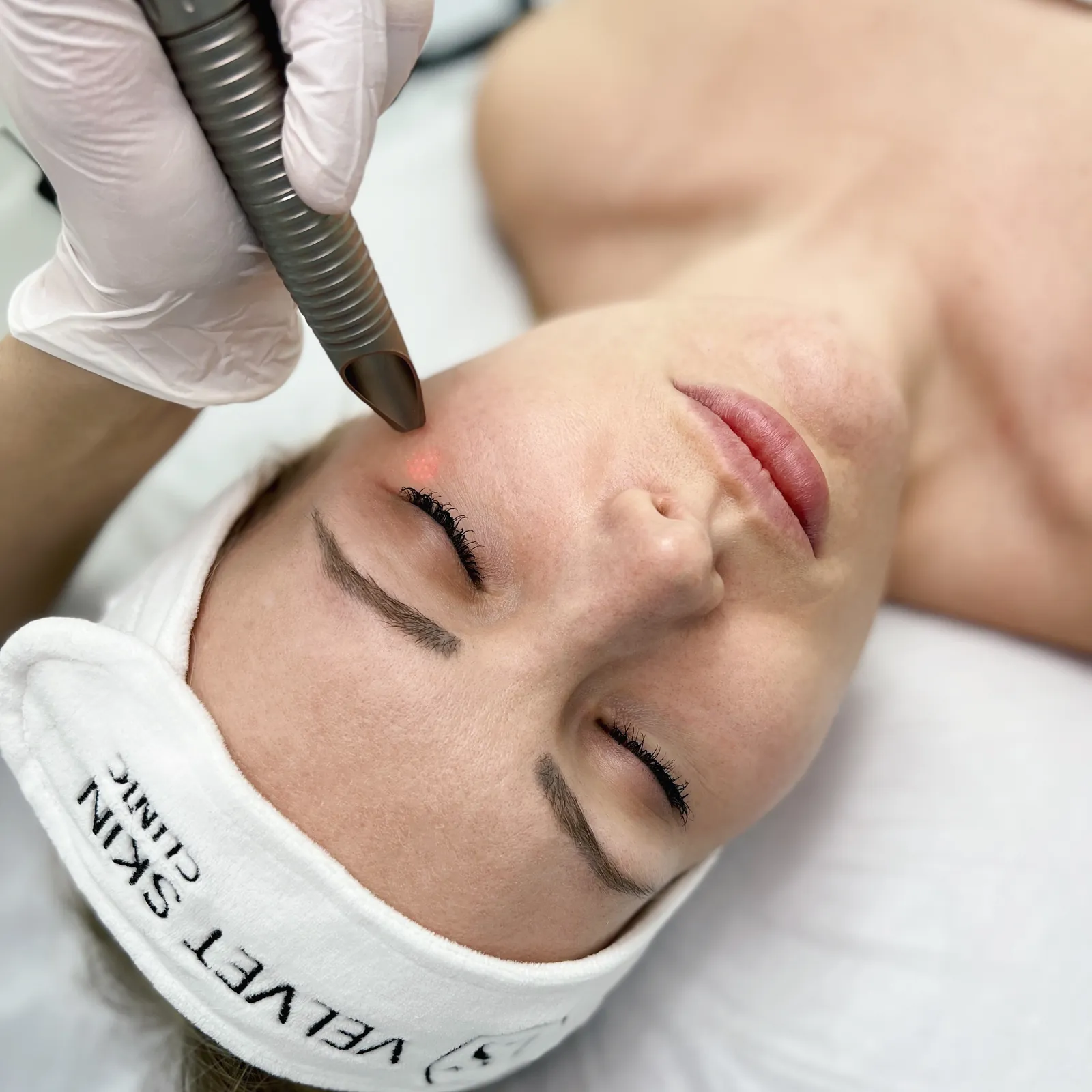 Laserowy lifting powiek SmoothEye™ — bez skalpela — Velvet Skin Clinic Warszawa