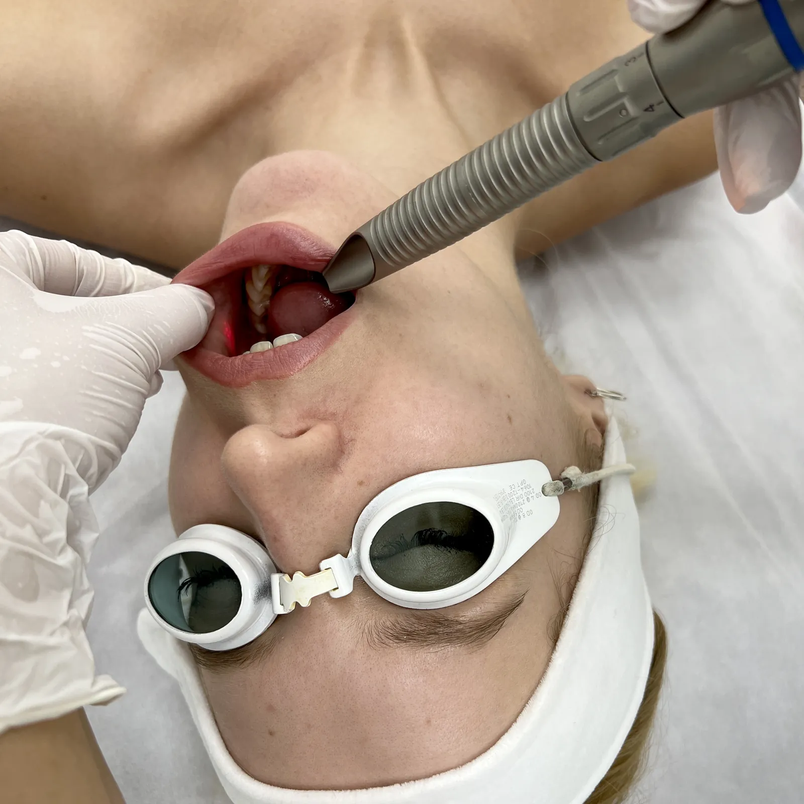 Lifting laserowy SMOOTH™ — ujędrnianie i remodeling skóry — Velvet Skin Clinic Warszawa