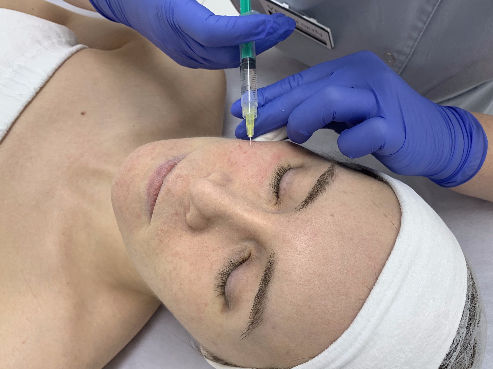 sunekos — okolica oczu — podanie preparatu — Velvet Skin Clinic