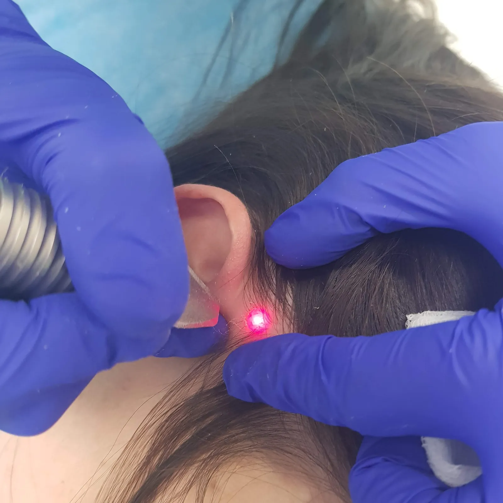 Usuwanie włókniaków i brodawek laserem Fotona™ — także tam, gdzie ich nie widzisz — Velvet Skin Clinic Warszawa