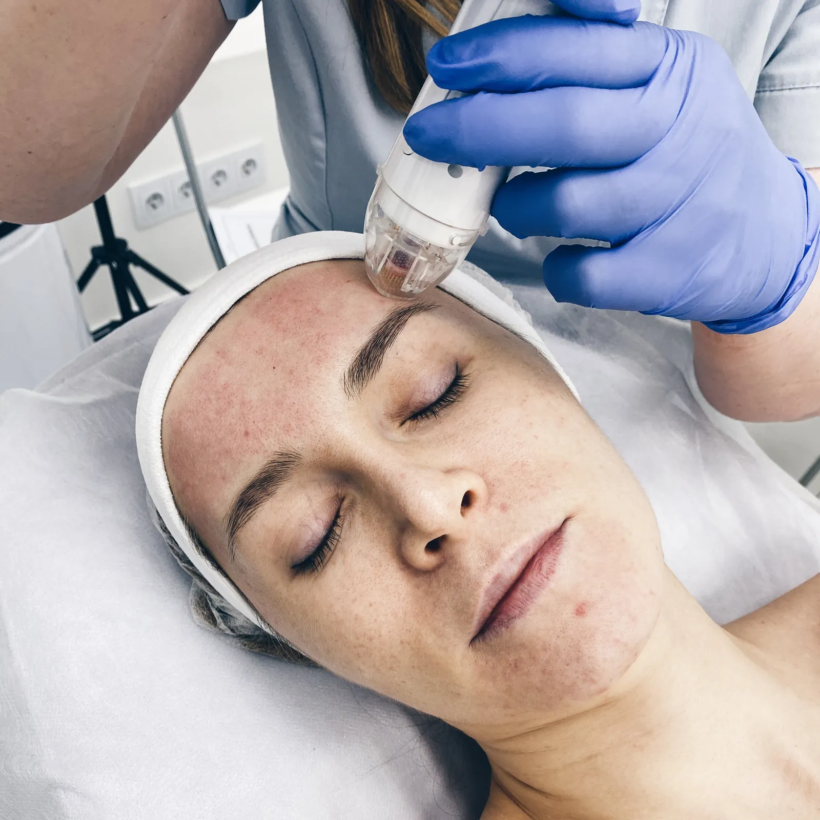 Radiofrekwencja mikroigłowa Vivace™ — lifting i odbudowa skóry — Velvet Skin Clinic Warszawa