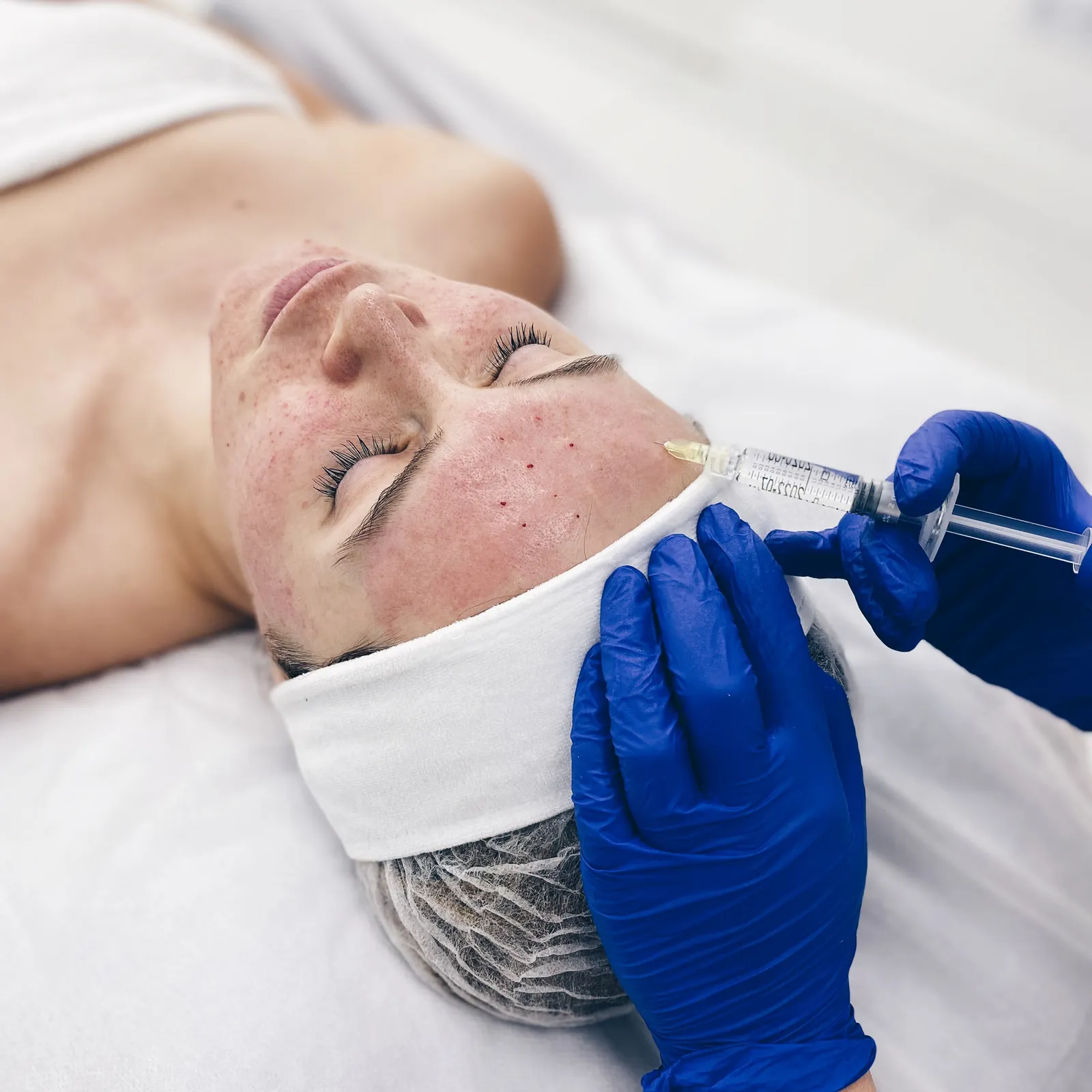 Redermalizacja Xela Rederm™ — odnowa skóry kwasem hialuronowym i bursztynianem sodu — Velvet Skin Clinic Warszawa
