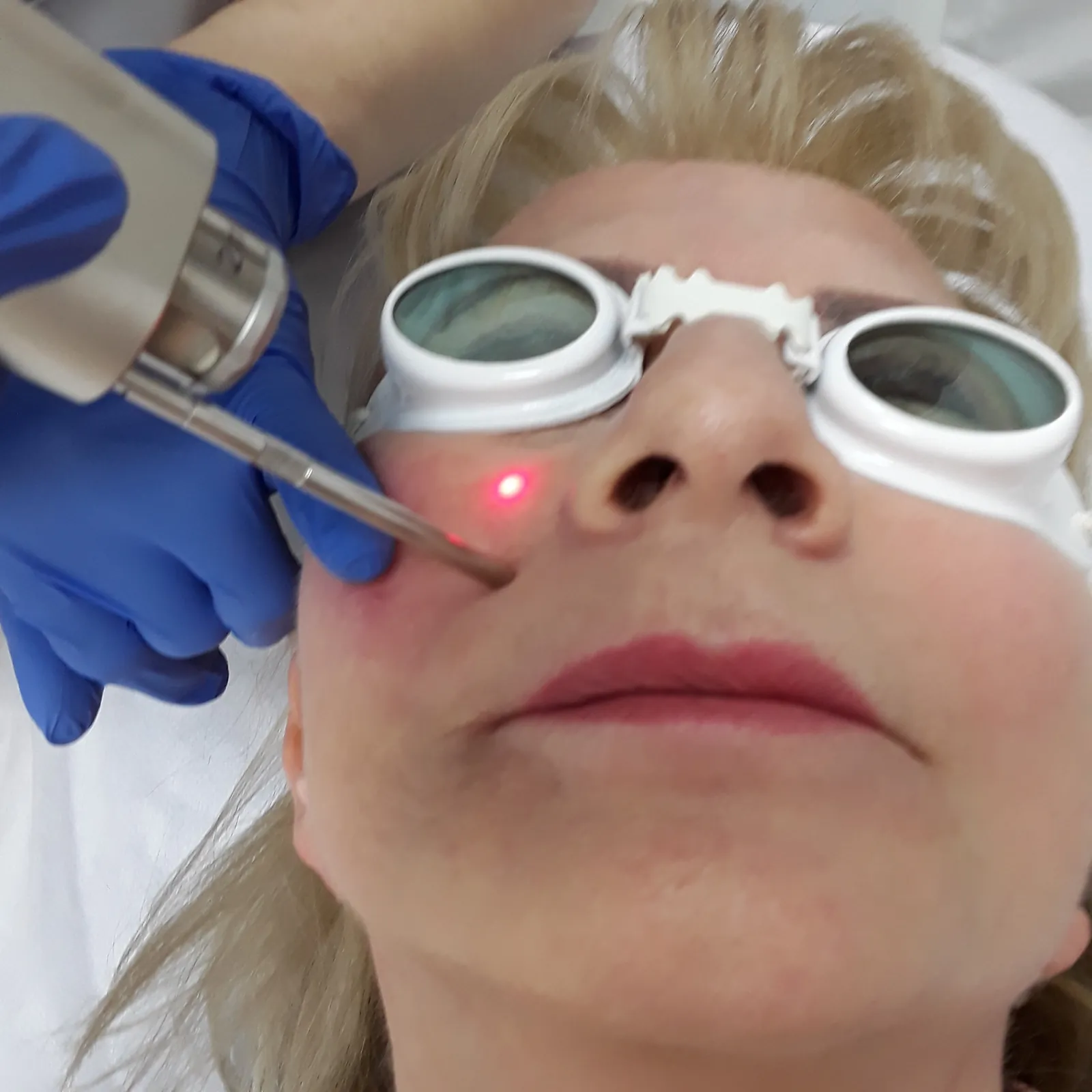 Laserowe zamykanie naczynek i rumienia — Velvet Skin Clinic Warszawa