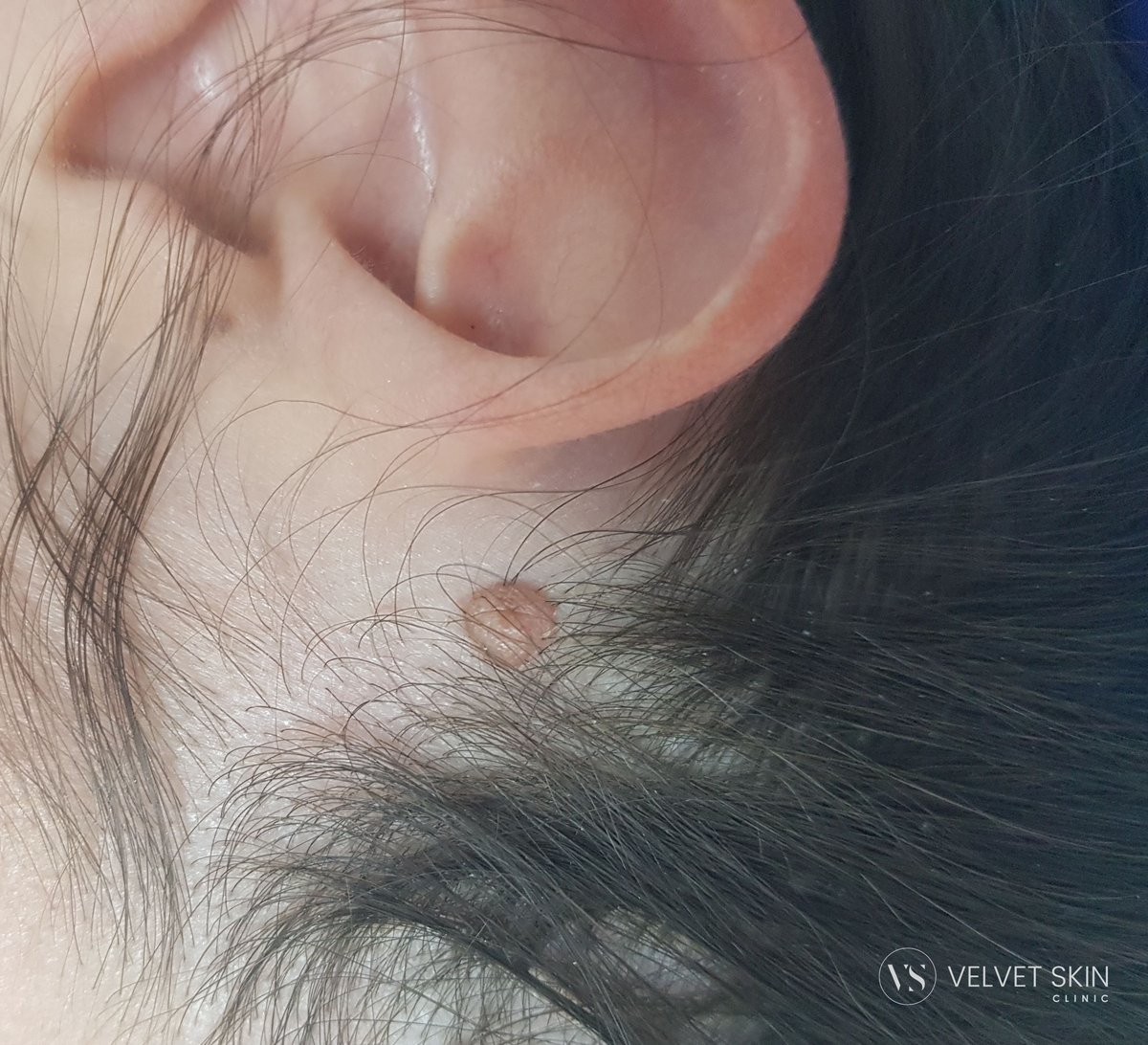 Brodawka łojotokowa w linii włosów przed usunięciem laserem. Velvet Skin Clinic Warszawa