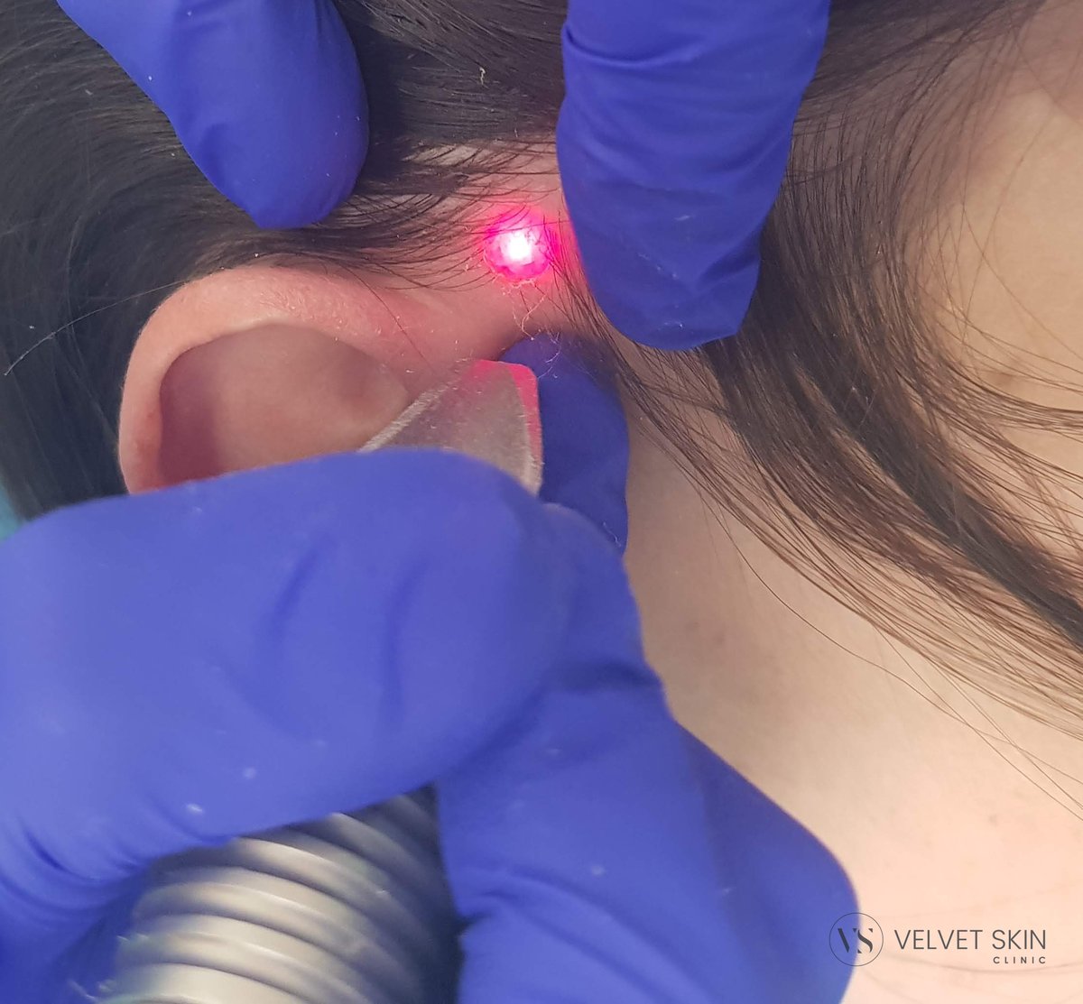 Praca laserem erbowym Er:YAG w okolicy zausznej — widoczny czerwony celownik. Velvet Skin Clinic Warszawa