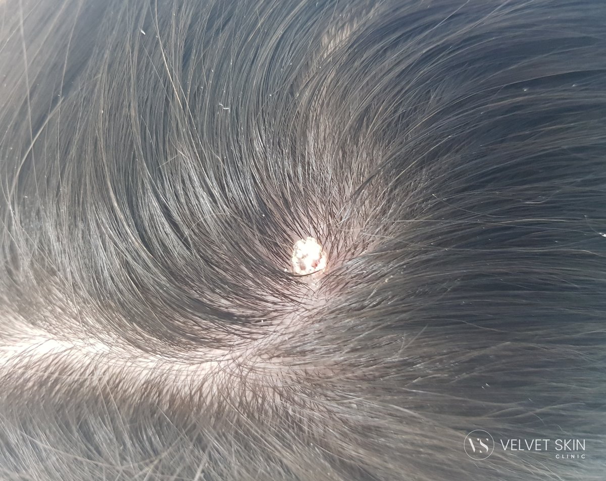 Miejsce po usunięciu zmiany w skórze głowy bezpośrednio po zabiegu — widoczny strup. Velvet Skin Clinic Warszawa