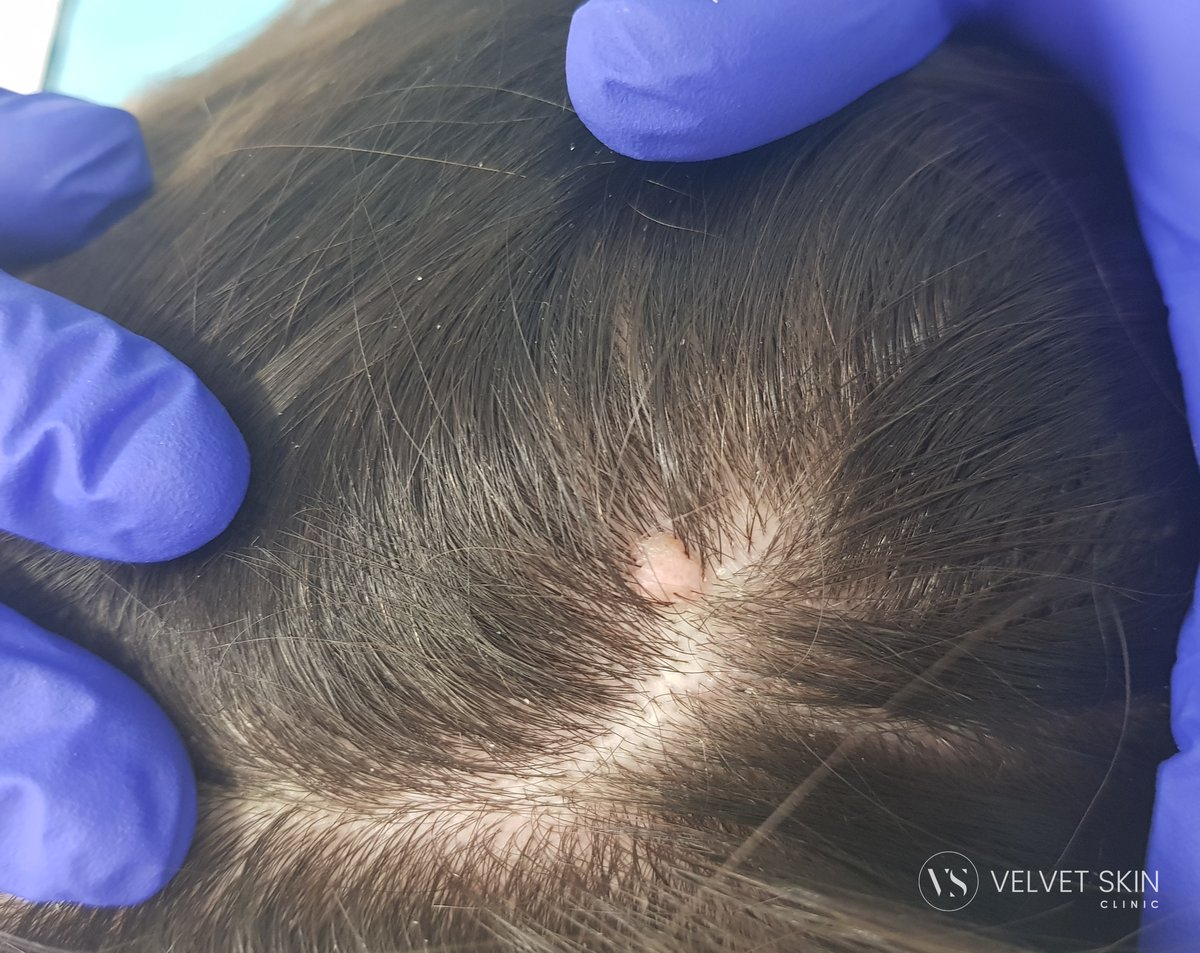 Brodawka łojotokowa w skórze owłosionej głowy przed zabiegiem laserowym. Velvet Skin Clinic Warszawa