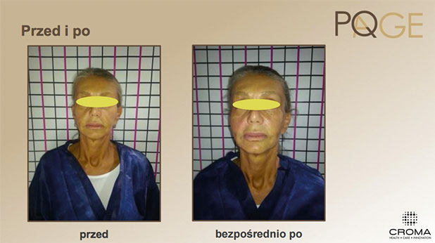 Peeling PQ Age™ Evolution — efekt zabiegów w Velvet Skin Clinic