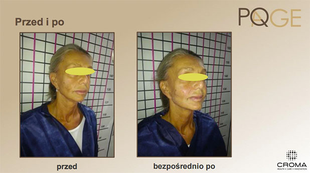 Peeling PQ Age™ Evolution — efekt zabiegów w Velvet Skin Clinic