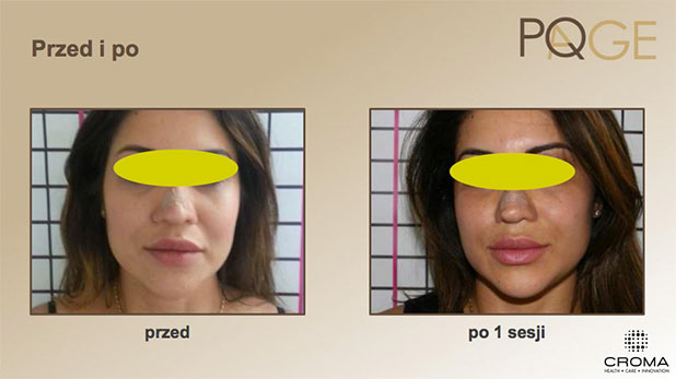 Peeling PQ Age™ Evolution — efekt zabiegów w Velvet Skin Clinic