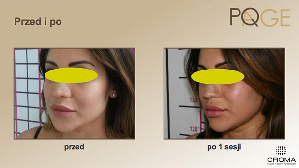 Peeling PQ Age™ Evolution — efekt zabiegów w Velvet Skin Clinic