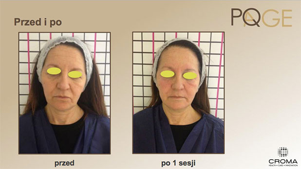 Peeling PQ Age™ Evolution — efekt zabiegów w Velvet Skin Clinic