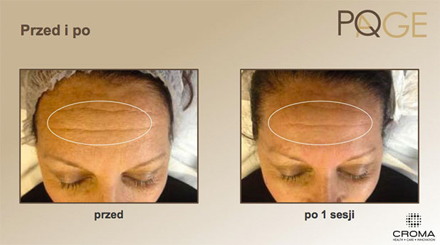 Peeling PQ Age™ Evolution — efekt zabiegów w Velvet Skin Clinic