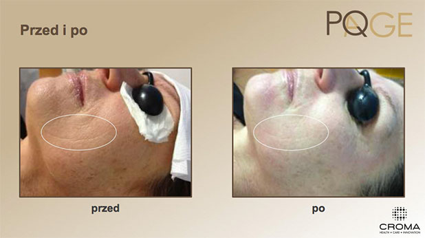 Peeling PQ Age™ Evolution — efekt zabiegów w Velvet Skin Clinic