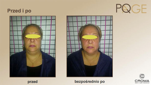Peeling PQ Age™ Evolution — efekt zabiegów w Velvet Skin Clinic