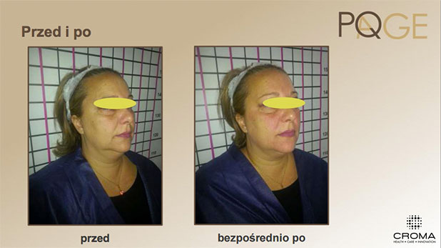 Peeling PQ Age™ Evolution — efekt zabiegów w Velvet Skin Clinic