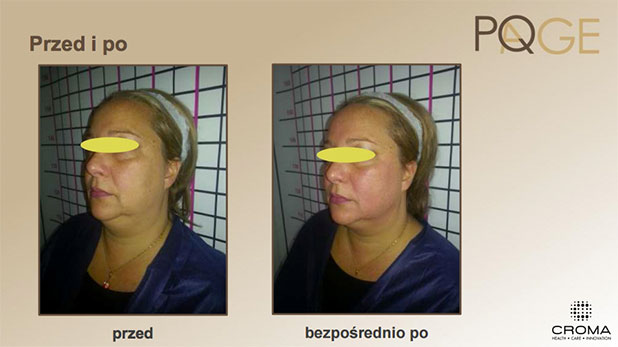 Peeling PQ Age™ Evolution — efekt zabiegów w Velvet Skin Clinic