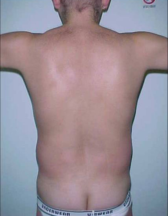 Lipoliza iniekcyjna — efekt przed zabiegiem, Velvet Skin Clinic Warszawa