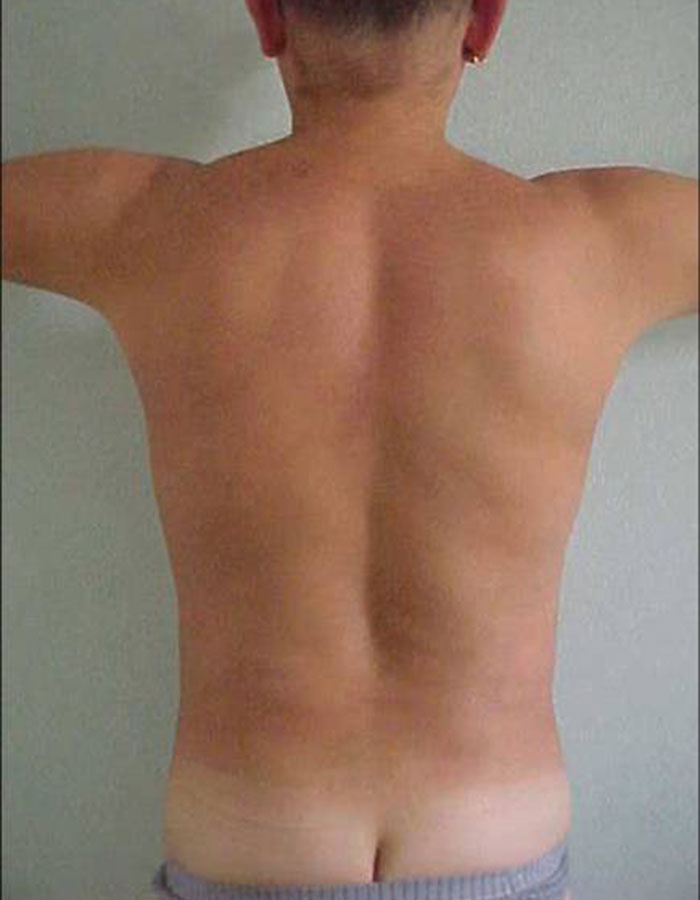 Lipoliza iniekcyjna — efekt po serii zabiegów, Velvet Skin Clinic Warszawa