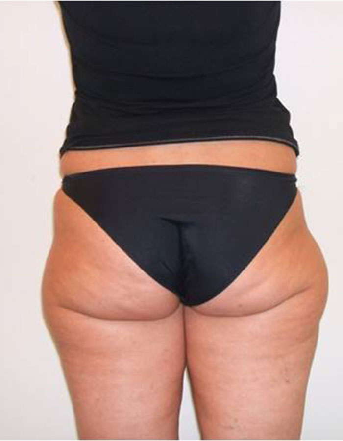 Lipoliza iniekcyjna — efekt przed zabiegiem, Velvet Skin Clinic Warszawa