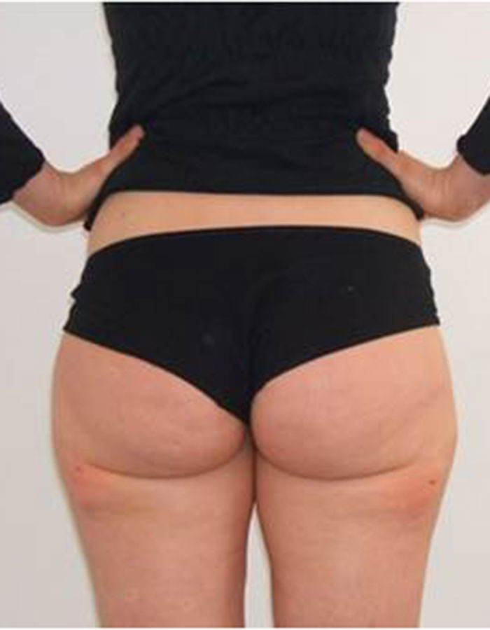 Lipoliza iniekcyjna — efekt po serii zabiegów, Velvet Skin Clinic Warszawa