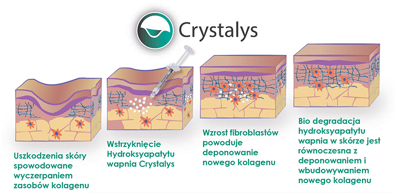 Crystalys™ — Zalety preparatu Crystalys