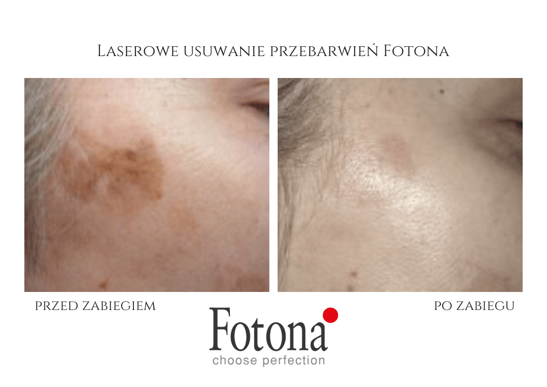 Laserowe usuwanie przebarwień — efekt przed i po zabiegu, Velvet Skin Clinic Warszawa