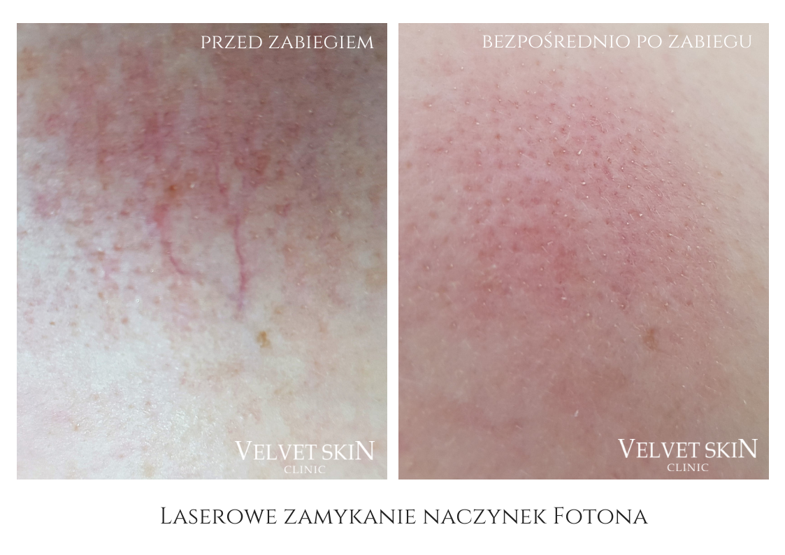Laserowe zamykanie naczynek i rumienia — efekt przed i po zabiegu, Velvet Skin Clinic Warszawa