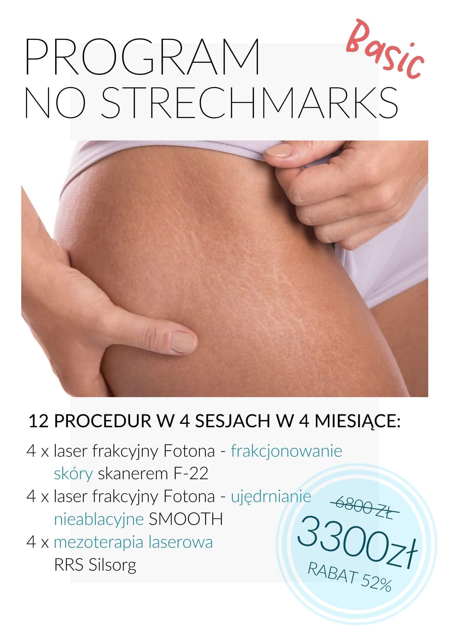 Program No Stretchmarks Basic — laserowa redukcja rozstępów
