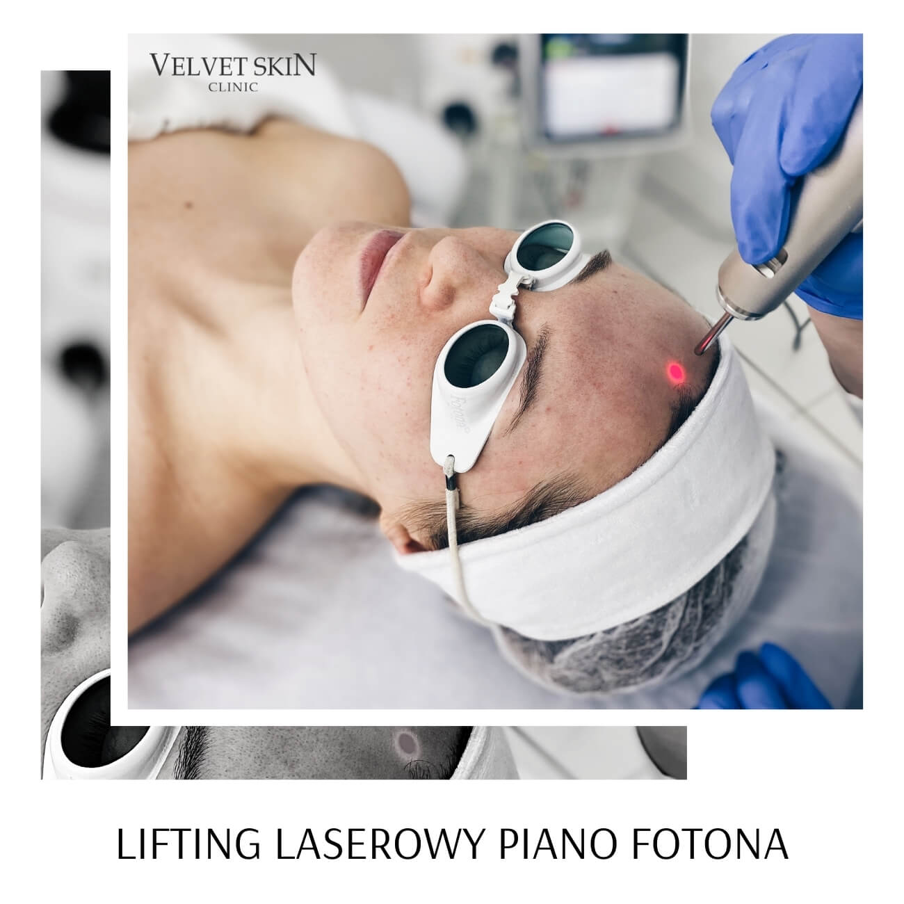 PIANO™ Laser Thermolifting — PIANO laser lifting: thermolifting, firming and skin remodelling