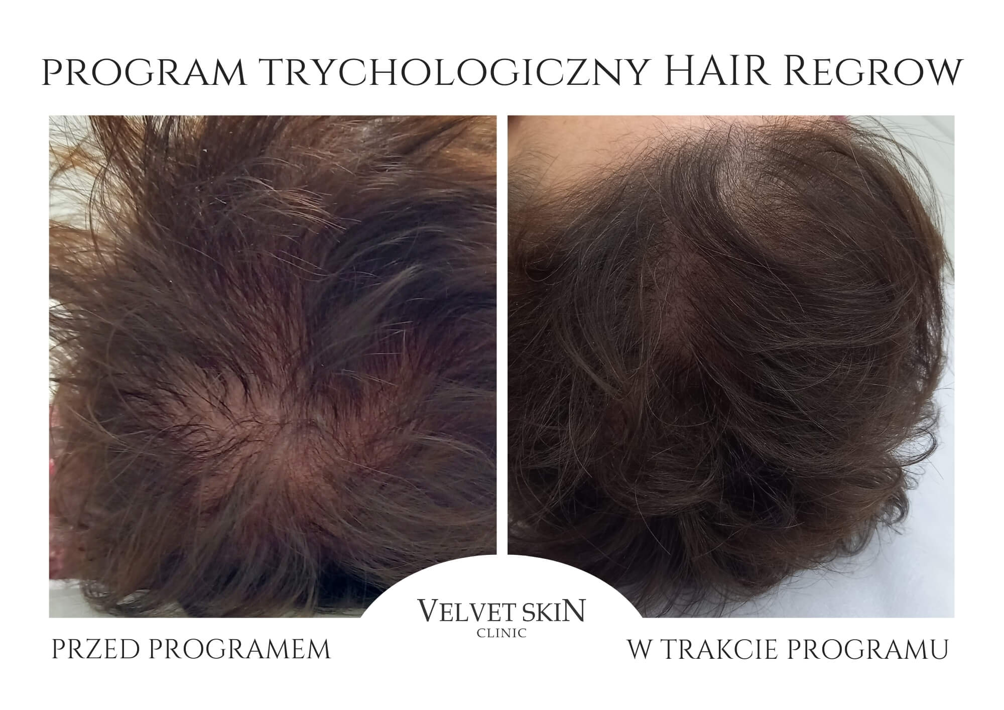 Program Hair Boost — efekt zabiegów w Velvet Skin Clinic