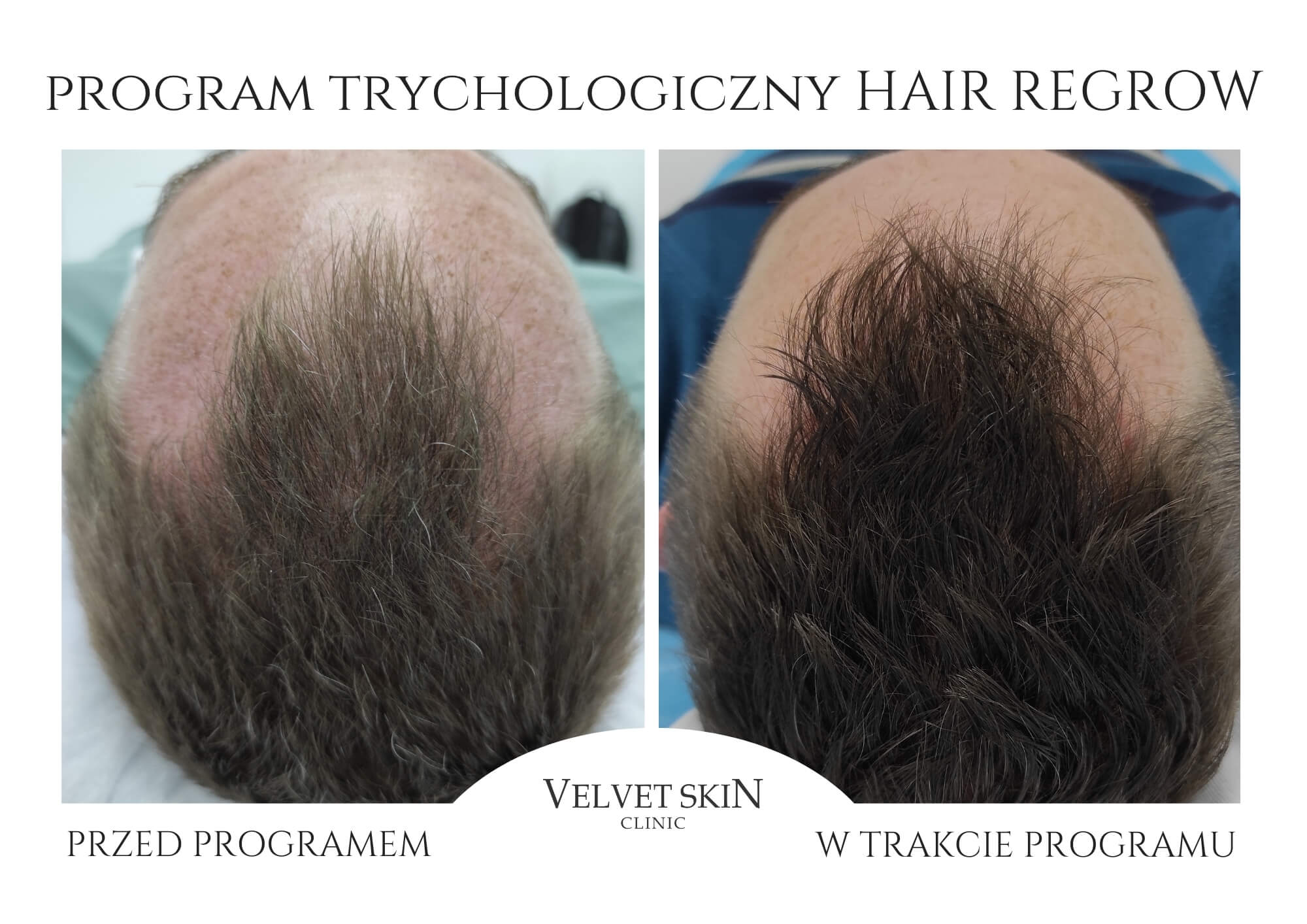 Program Hair Boost — efekt zabiegów w Velvet Skin Clinic