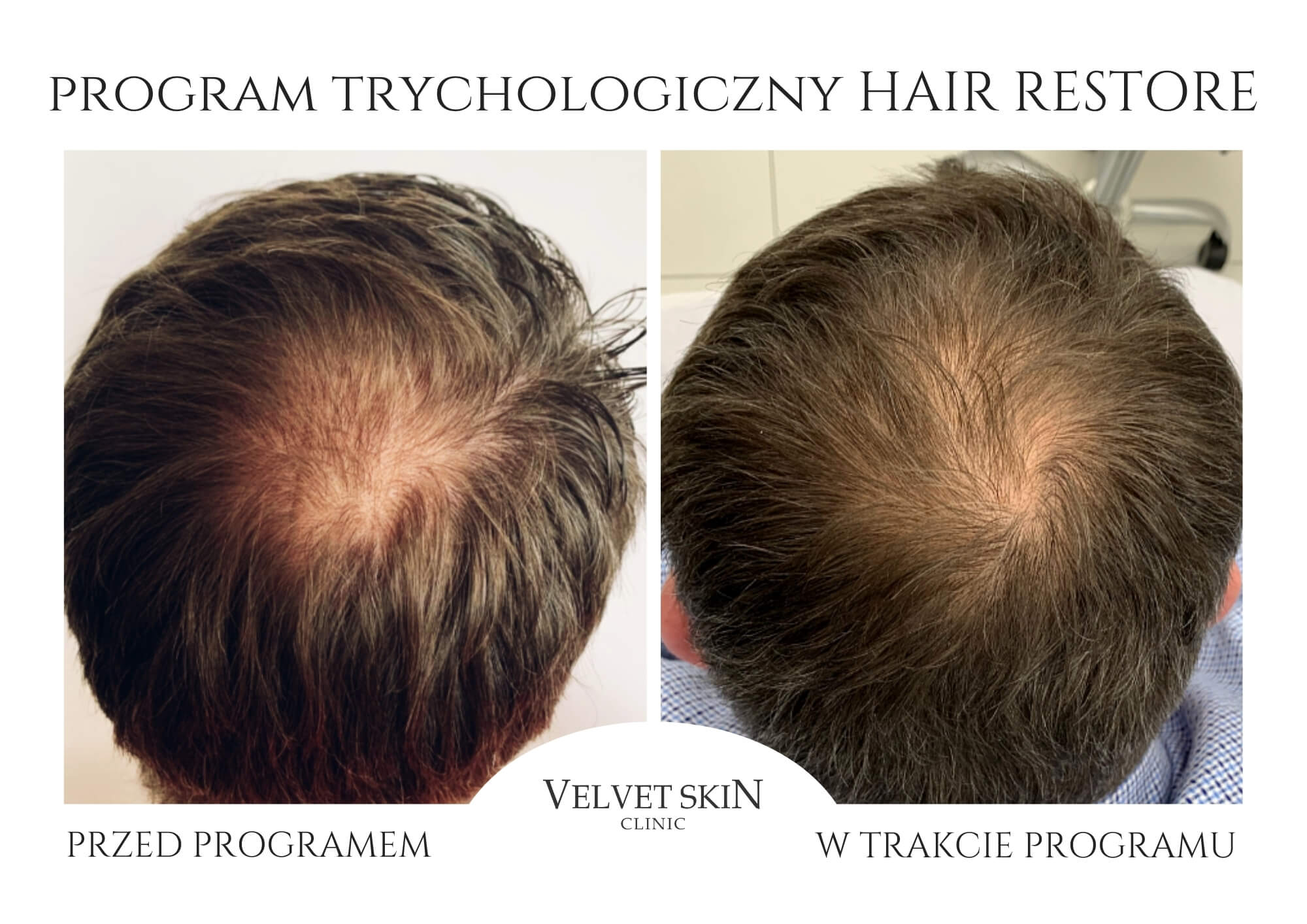 Program Hair Restore — efekt zabiegów w Velvet Skin Clinic