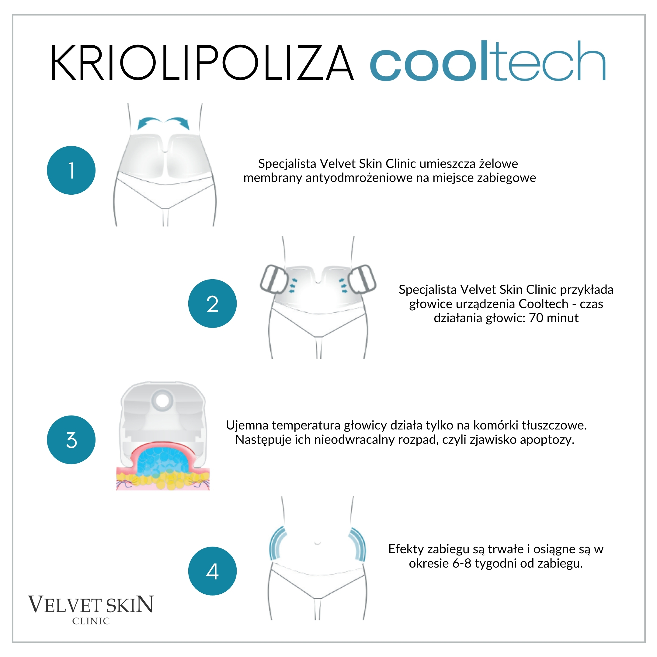 Kriolipoliza Cooltech — etapy przebiegu zabiegu (infografika)