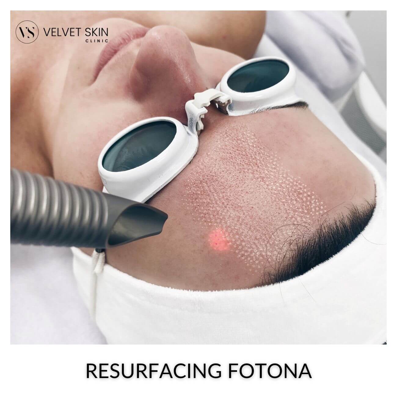 Fractional Er:YAG Fotona laser — skin resurfacing treatment at Velvet Skin Clinic Warsaw