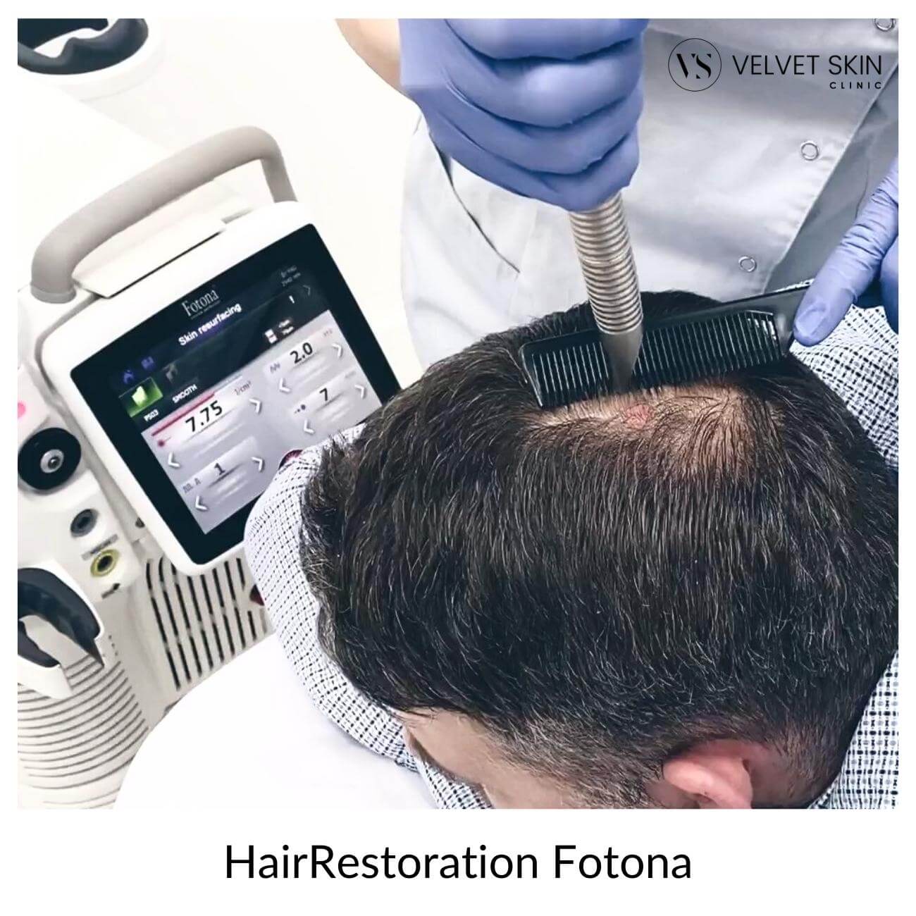 hair restoration zabieg dla mężczyzn