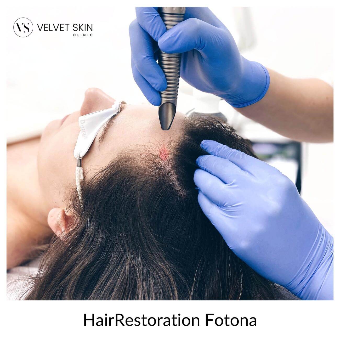 hair restoration - kosmetolog wykonuje zabieg fotona