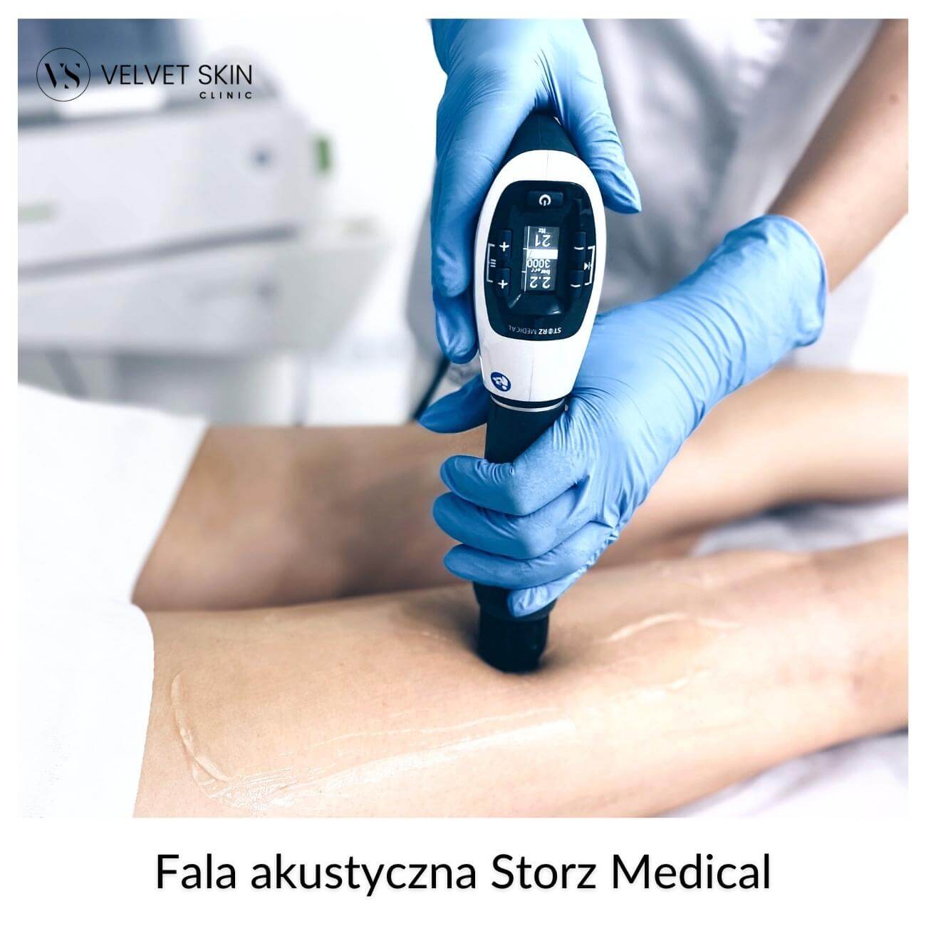 Fala akustyczna Storz Medical™ — Fala akustyczna Storz Medical™️ w leczeniu cellulitu