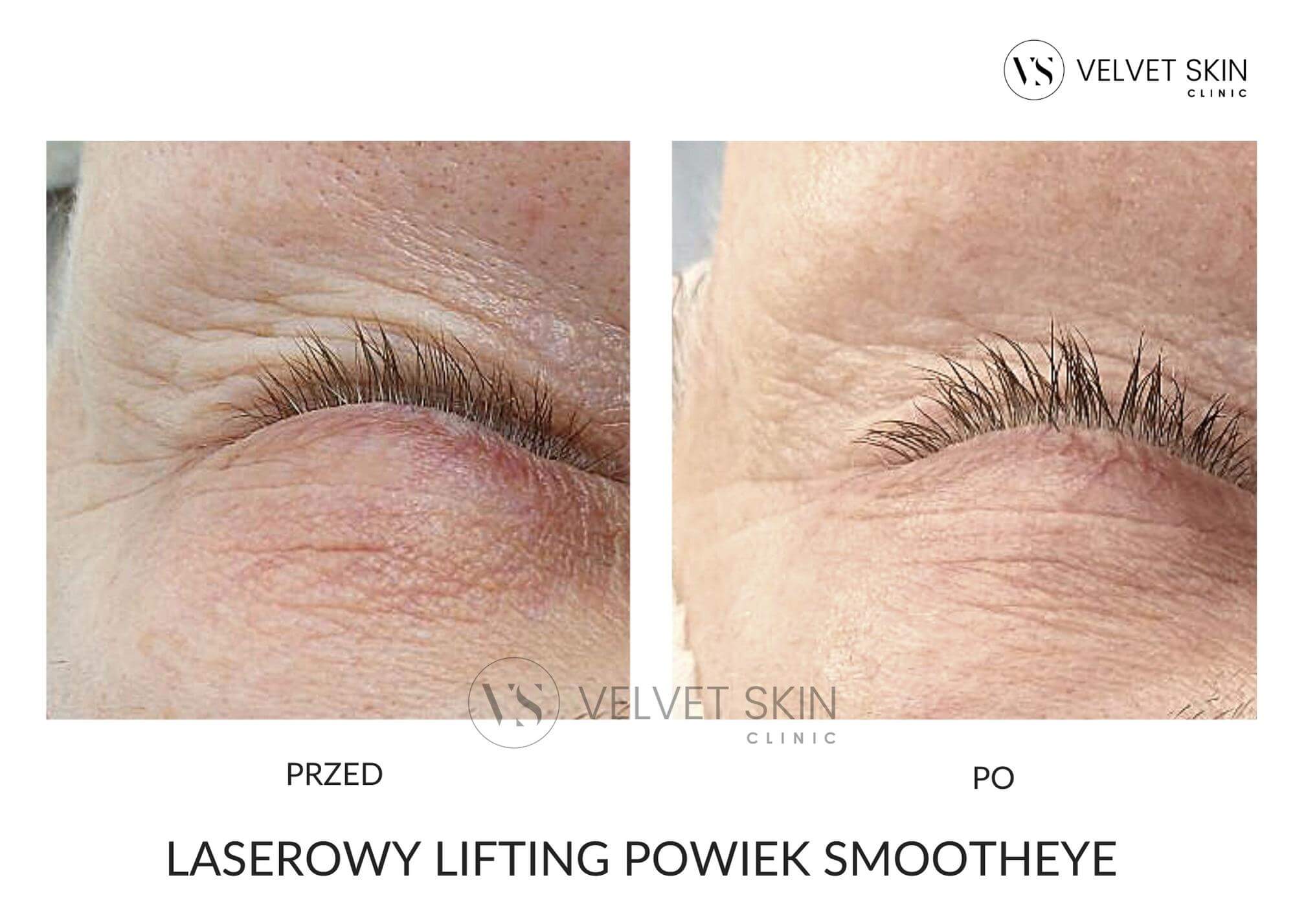 Laserowy lifting powiek SmoothEye — efekt przed i po zabiegu okolicy oczu, Velvet Skin Clinic Warszawa
