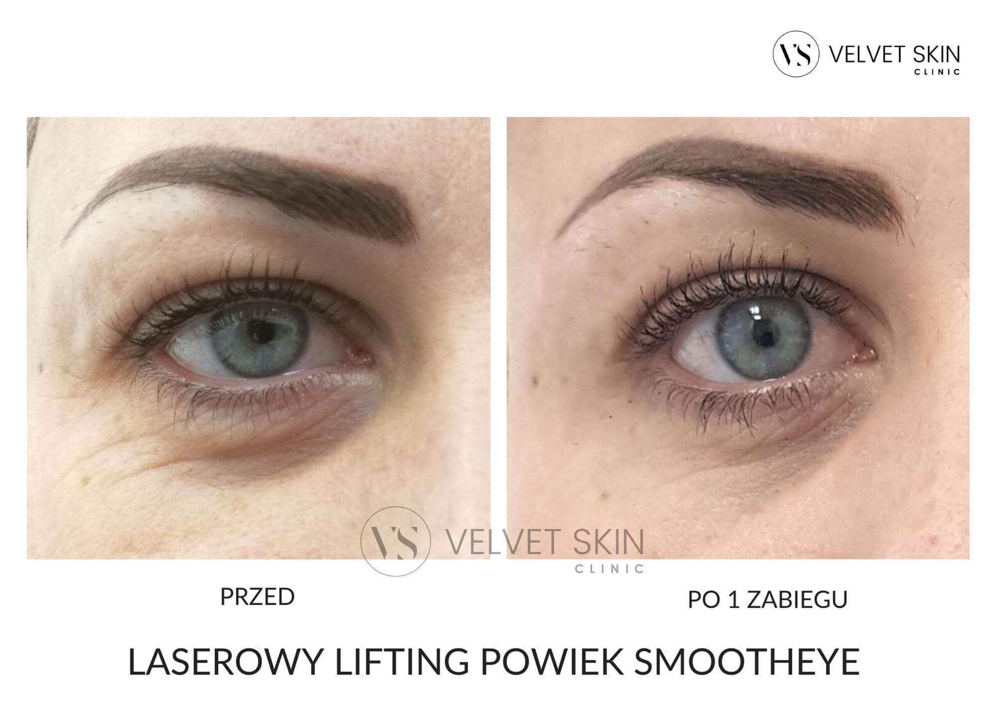 Laserowy lifting powiek SmoothEye — efekt przed i po zabiegu (widoczna liczba sesji), Velvet Skin Clinic Warszawa